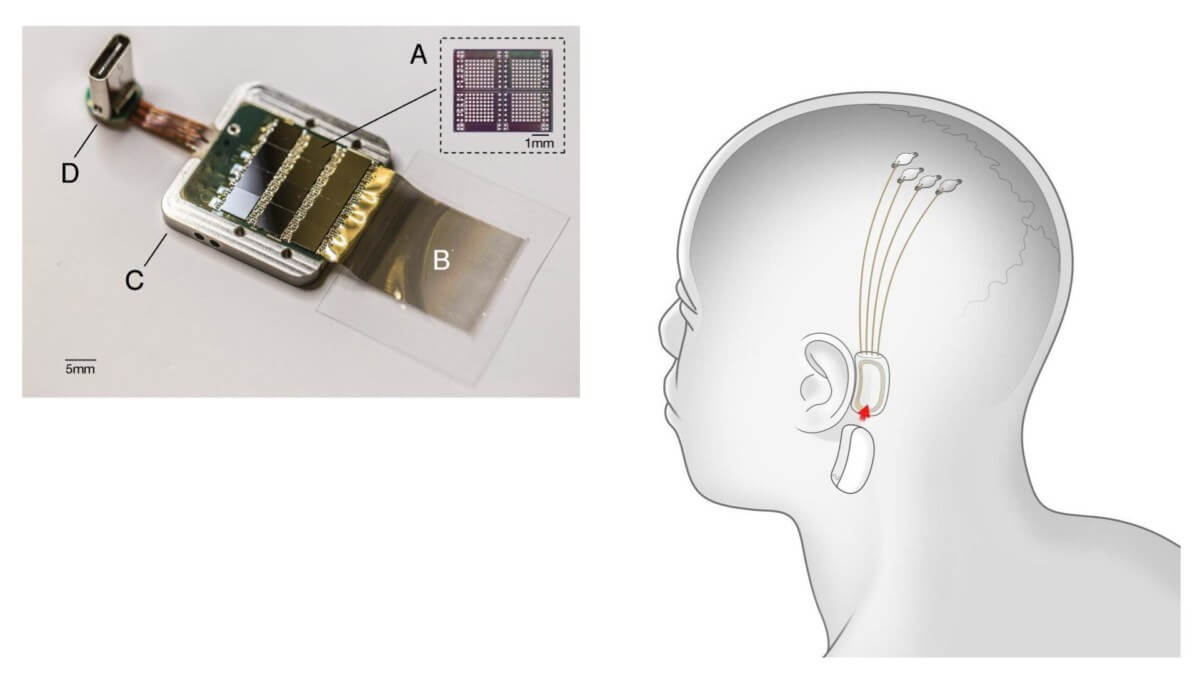 Neuralink brain chip implant elon musk brain tech science technology